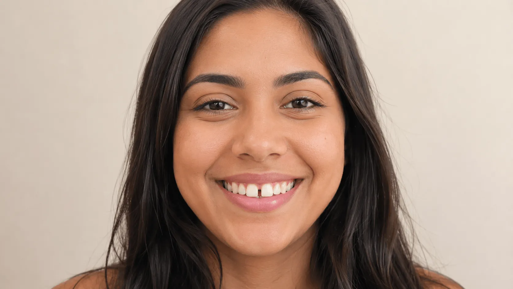 Caso 3 antes, diastema visível entre dentes frontais