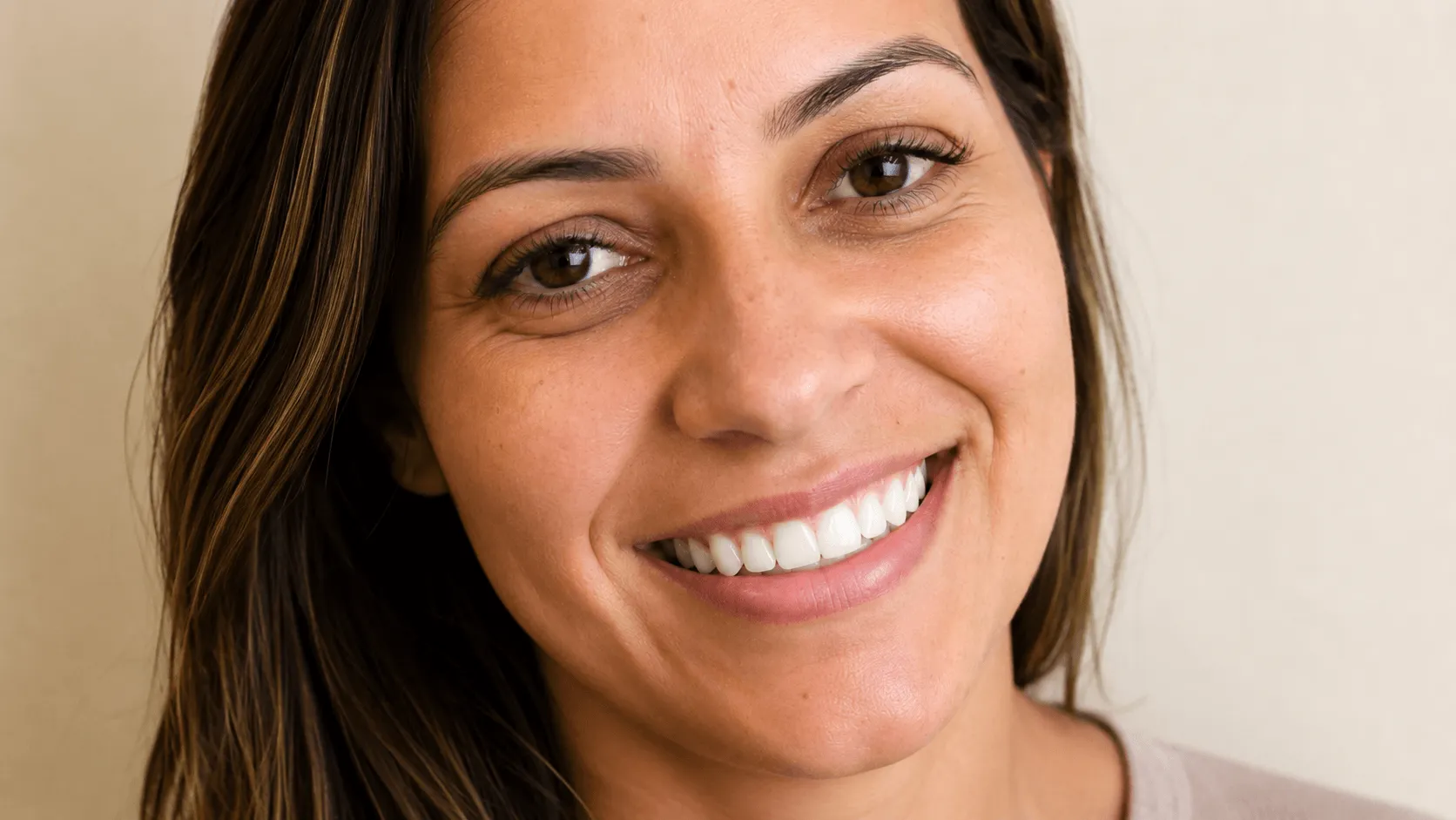 Caso 6 depois, sorriso harmonizado e simétrico com lentes